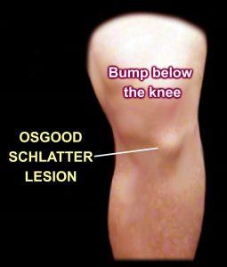 tibial tuberosity swells - five dock