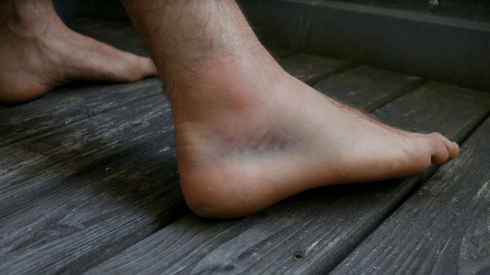 How Should I Manage My Ankle Injury?