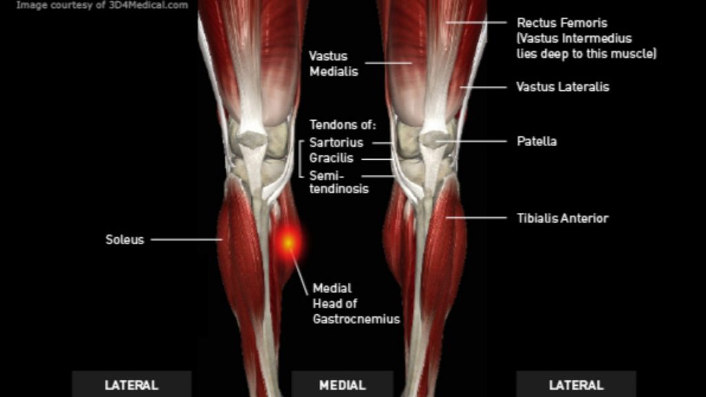 gastrocnemius tear