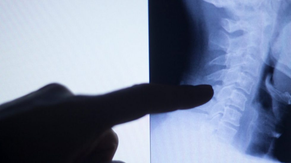 What can I do about neck Osteoarthritis