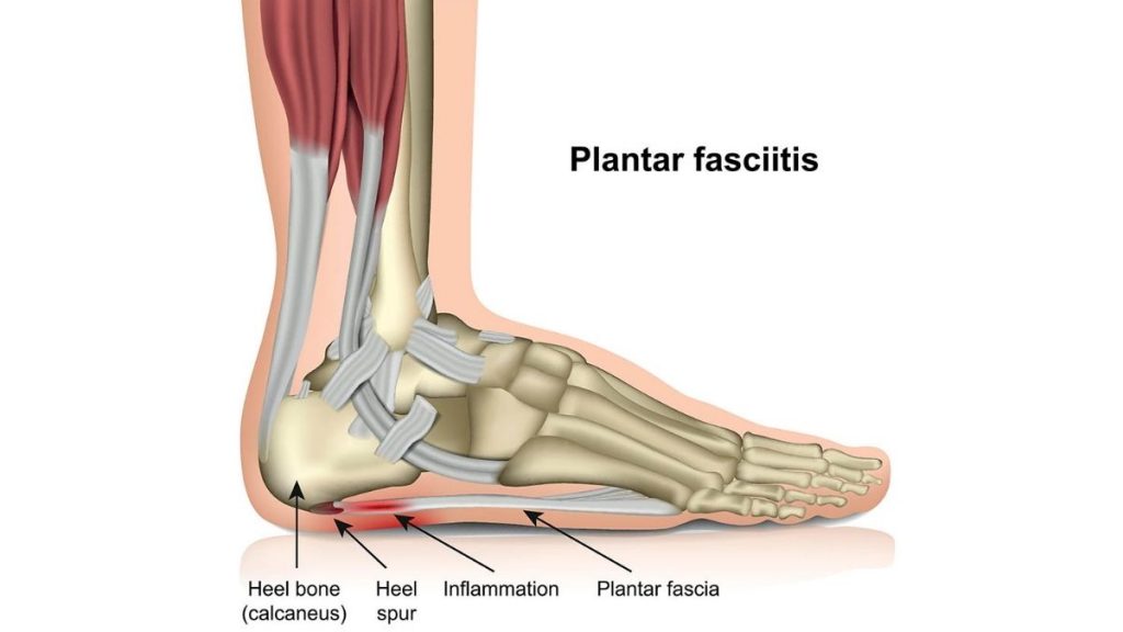 Plantar Fasciitis - Gemini Osteopathy