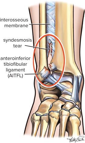 high ankle sprain recovery time