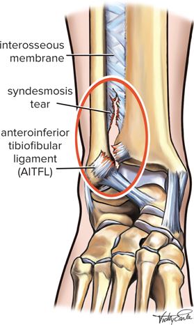 High Ankle Sprain