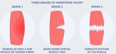 Why should I get my hamstring tear assessed?