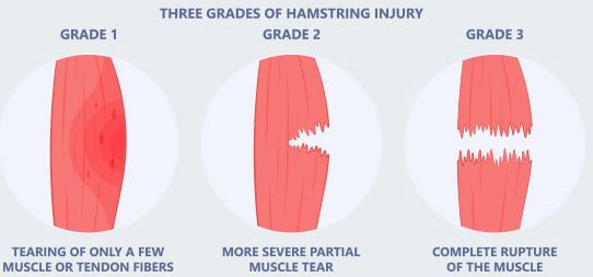 Hamstring tears anatomy crop