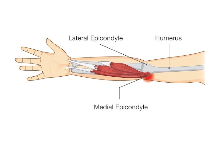 Medial Epicondyle Golfers Elbow