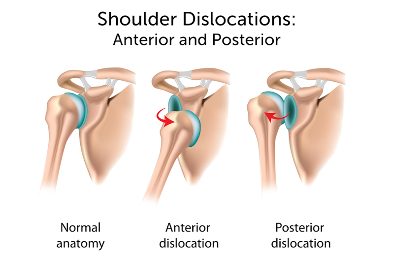 shoulder-dislocation