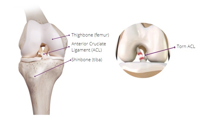 acl anterior cruciate ligament injuries