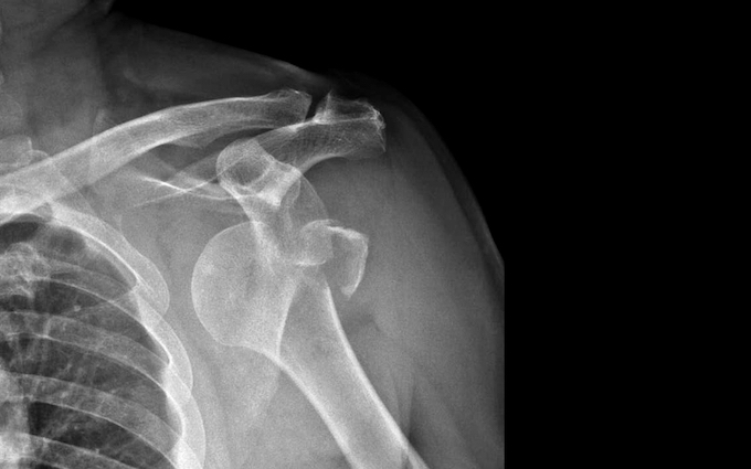 Shoulder dislocation x-ray