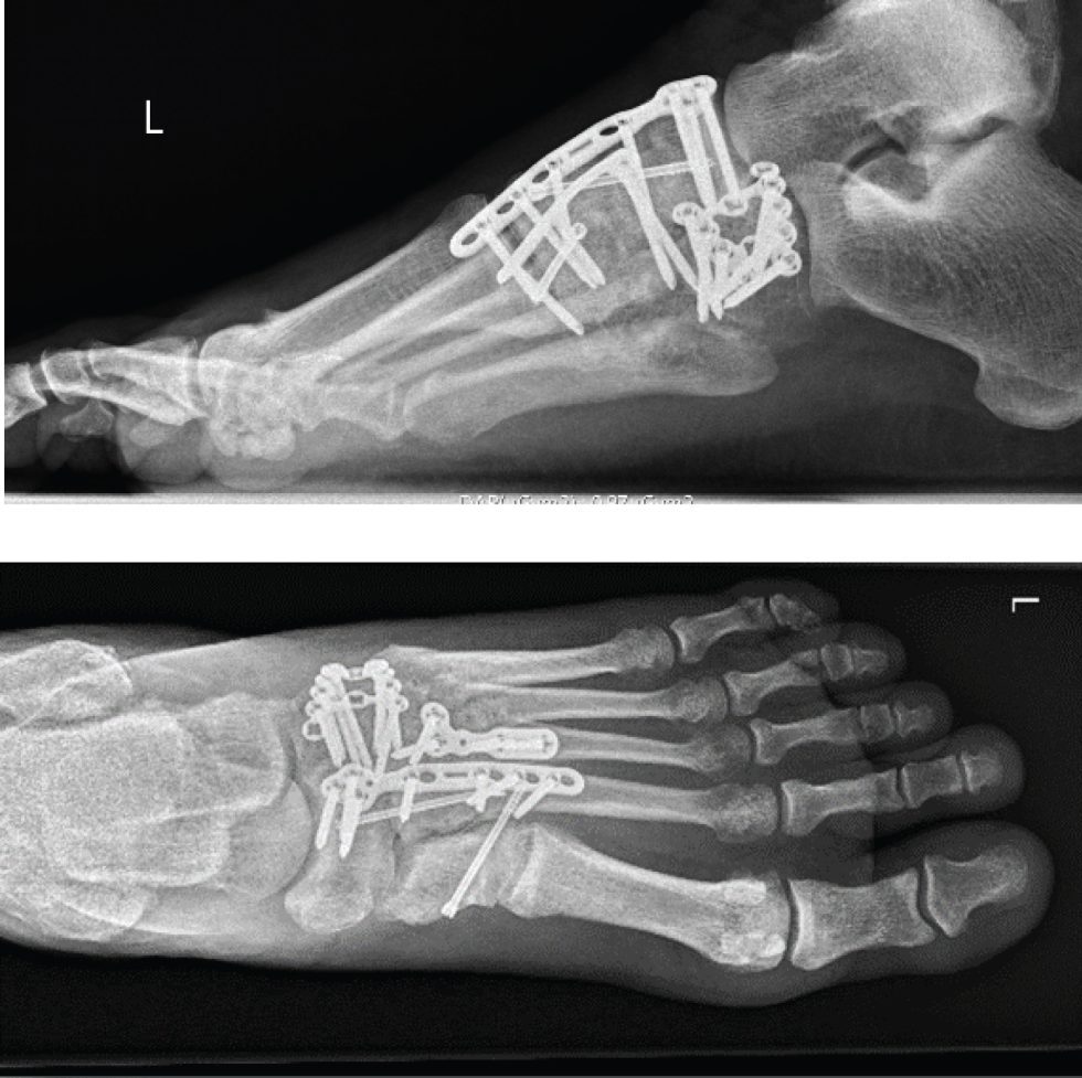 lisfranc-injury