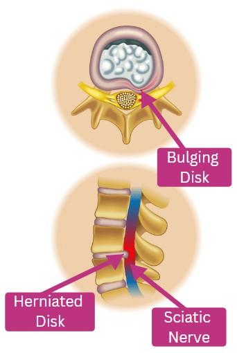 Bulging Disk Herniated Disk Sciatic Nerve