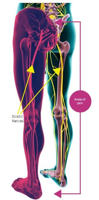 Sciatica Anatomy - five dock