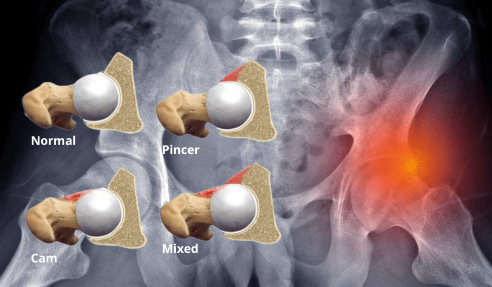 Hip Impingement