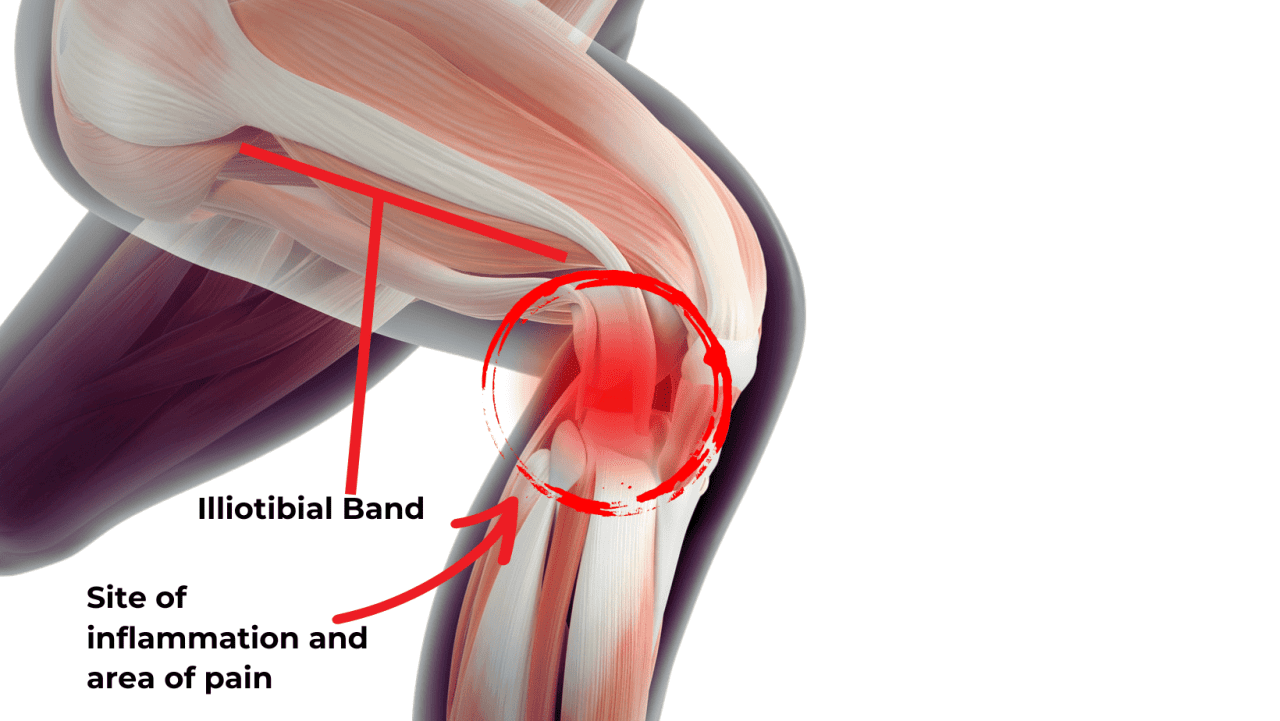 Iliotibial Band Syndrome Itbs